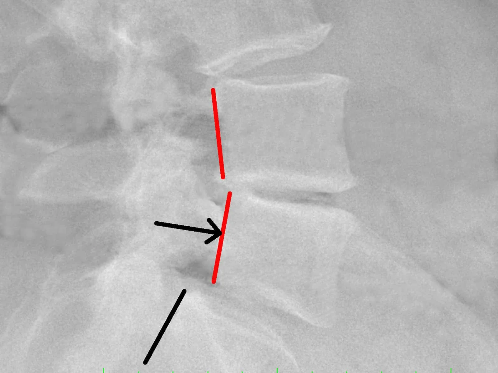 spondilolistesi
