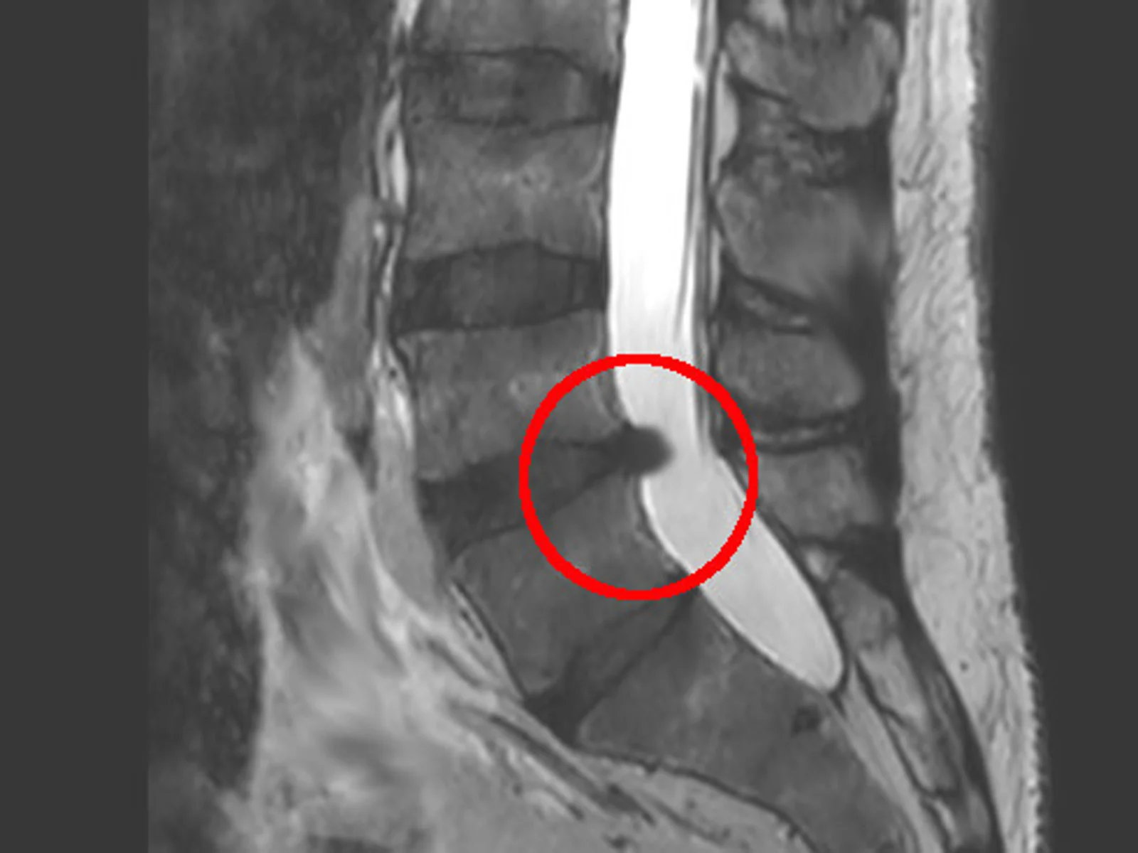 mri ernia al disco