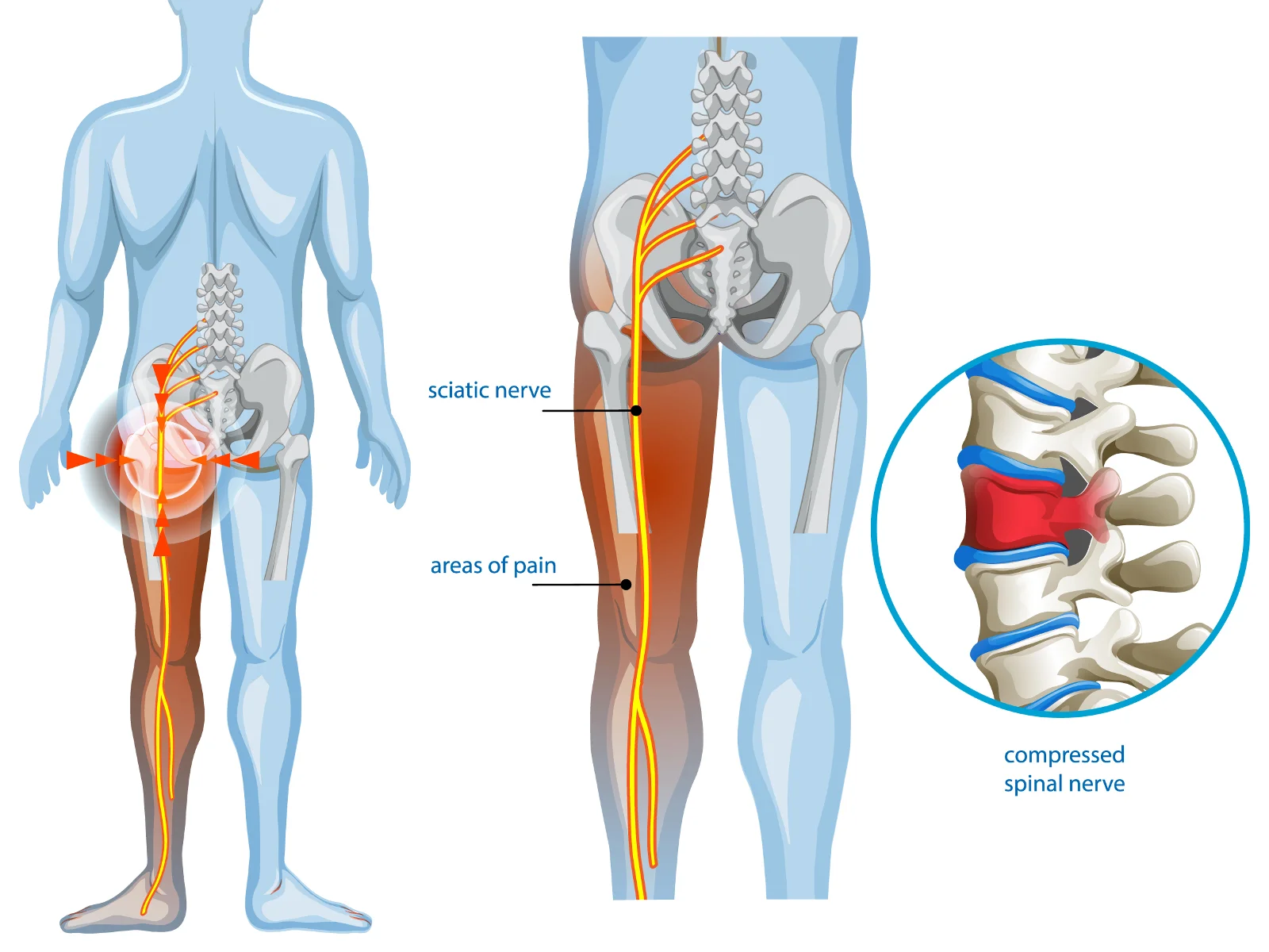 sciatica