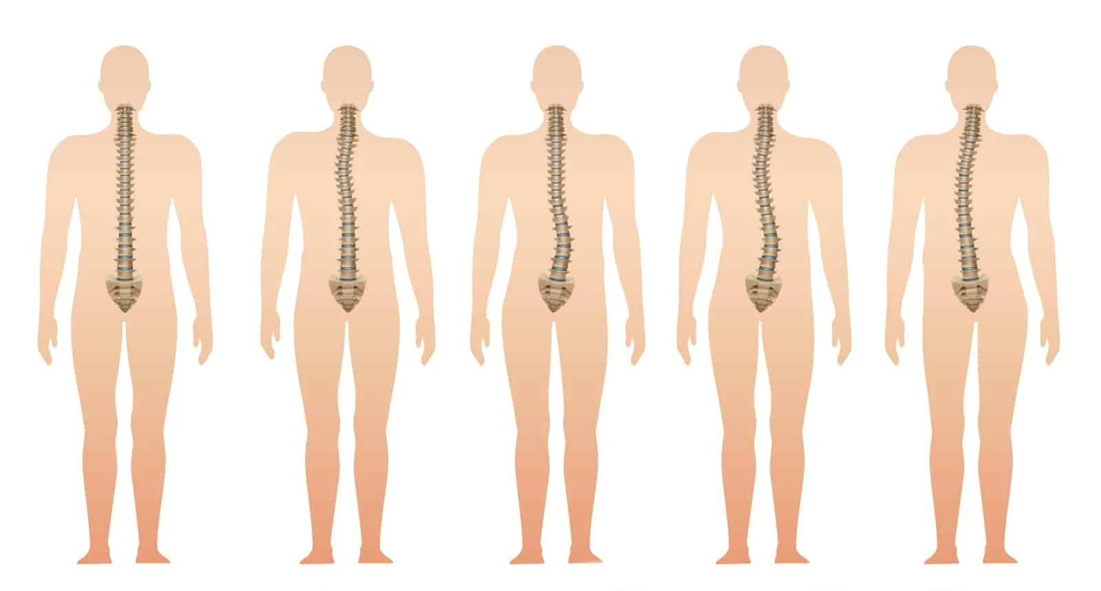immagine vettoriale di persone affiancate che mostra una colonna vertebrale funzionale allineata e vari tipi di colonna vertebrale disfunzionali disallineate