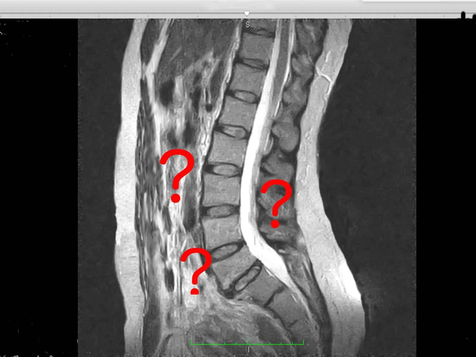 Un Caso di Sciatalgia Idiopatica